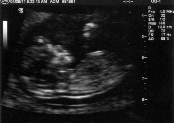 Ultrasound image