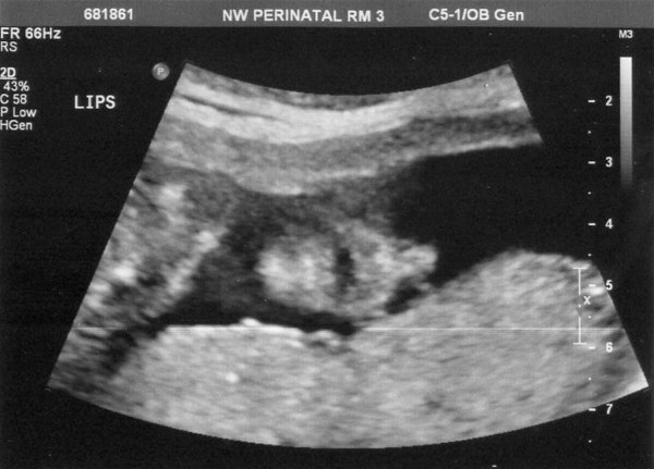 Ultrasound image
