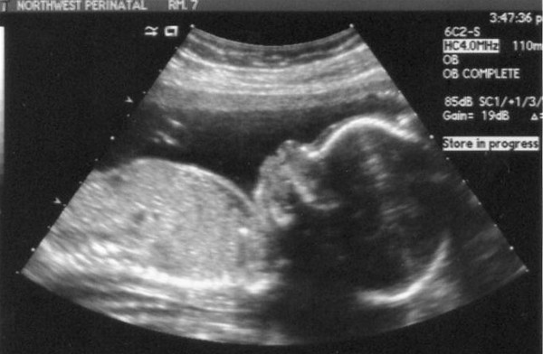 Ultrasound image
