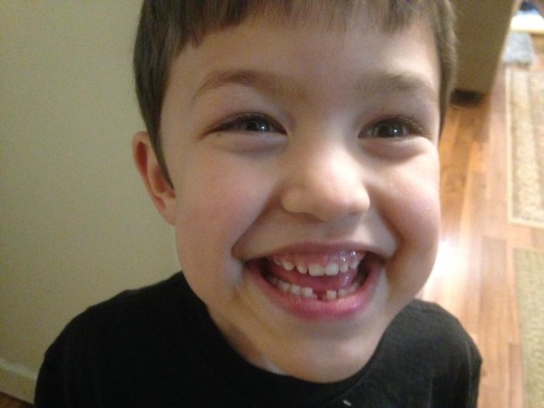 Cody with missing tooth