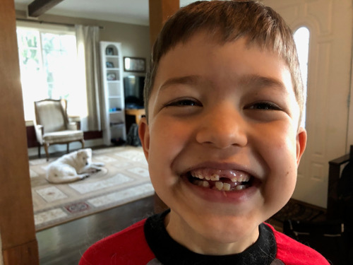 Three missing teeth
